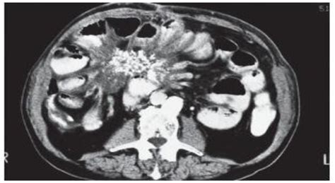 Figure 3 from THE ROLE OF IMAGING IN DIFFERENTIATING SCLEROSING ...