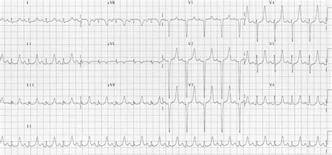 Hyperkalaemia ECG changes • LITFL • ECG Library