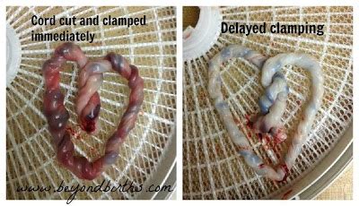 Why "Delayed" Cord Clamping Should Be the Norm | Evolutionary Parenting | Where History And ...