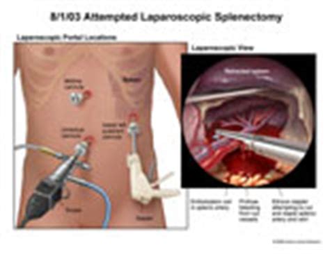 AMICUS Illustration of amicus,injury,surgery,splenic,artery,laparoscopic,splenectomy,stapler ...