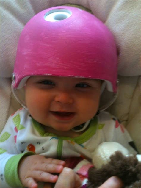 Helmet Use For Plagiocephaly