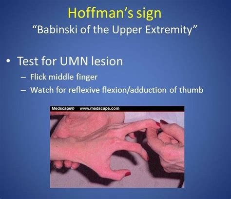 Hoffmans sign ... Babinski of upper limb ... | CNS | Pinterest