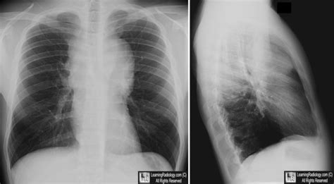 LearningRadiology-Hodgkin, disease, lymphoma, pulmonary, lung, adenopathy. mediastinal