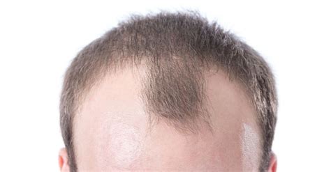 How to Stop Receding Hairline? 9 Science Backed Tips to Follow!