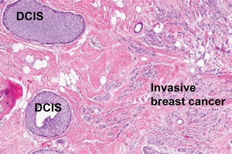 Forensic Techniques Enable Study of Individual Breast Cancer Cells from ...