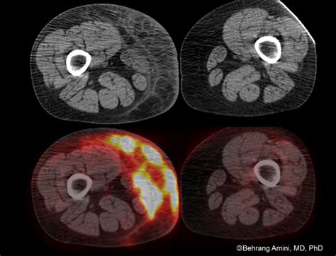 Roentgen Ray Reader: Subcutaneous Panniculitis-Like T-Cell Lymphoma