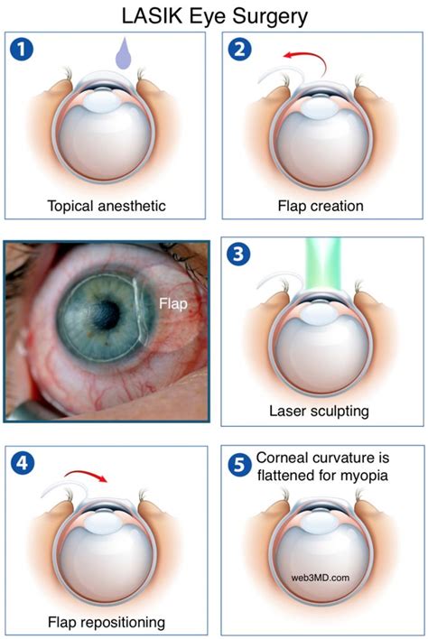 LASIK Eye Surgery for Vision Correction at Fort Worth Eye Associates