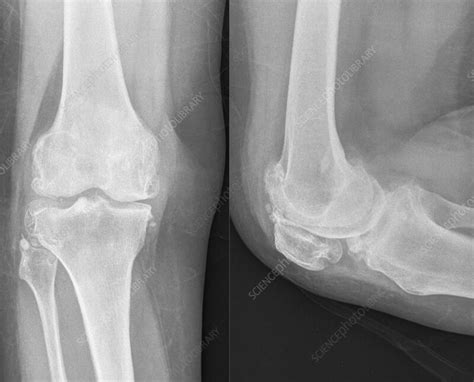 Knee osteoarthritis, X-ray - Stock Image - F036/5327 - Science Photo Library