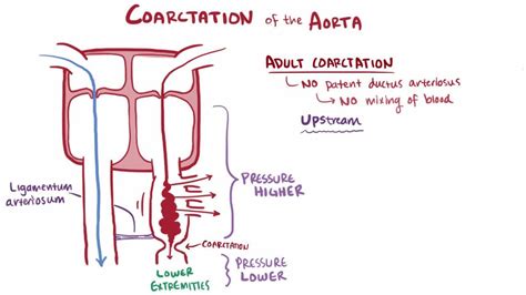 Coarctation of the Aorta - Coarctation of the Aorta - MSD Manual Professional Edition