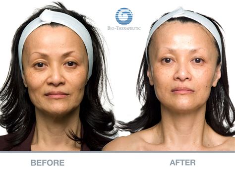 Microcurrent Facials Longmont, CO | aRejuvenation Skin Care