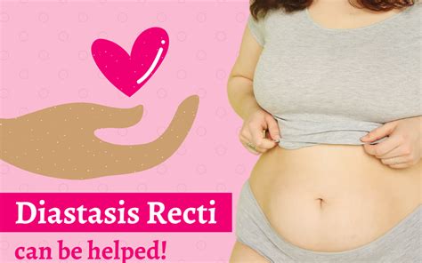 Diastasis Recti can be helped! - Dr Amruta Inamdar - Pelvic Floor Physical Therapy
