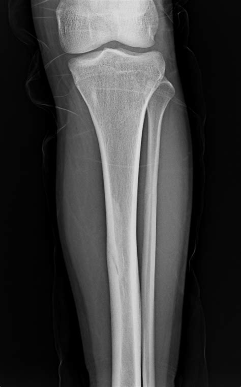 Stress Fracture X Ray Tibia