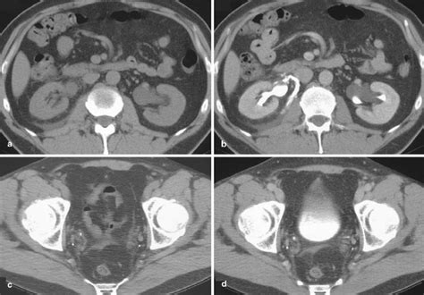 a Perinephric stranding surrounding the right kidney with fluid ...