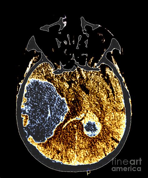 Massive Intracranial Hemorrhage, Ct Scan Photograph by Living Art Enterprises - Pixels