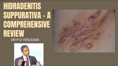 Hidradenitis suppurativa - a comprehensive review of all treatments ...