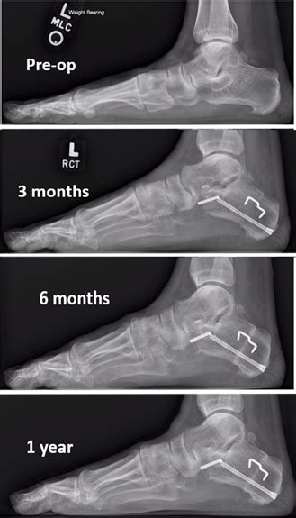 The Cotton Osteotomy in Flexible Flatfoot Correction