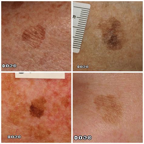 Mimics of skin cancer (i) - Skin Cancer 909