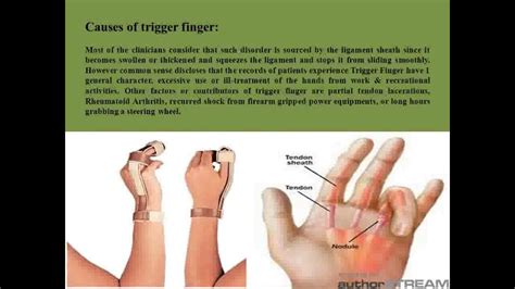 Trigger Finger Definition Etiology Symptoms Diagnosis