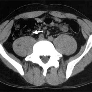 Cystic pneumatosis coli with pneumointestinalis (arrow) in case 2. | Download Scientific Diagram