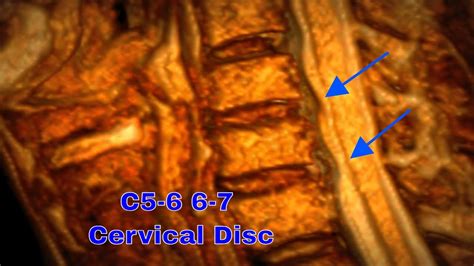 C5-6 6-7 Cervical Disc Herniation: 3D MRI Findings - YouTube