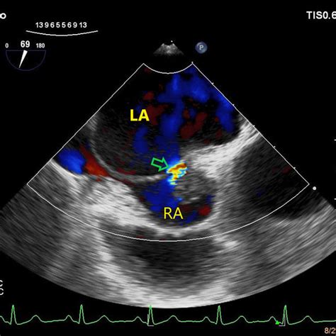 Transesophageal echocardiography shows a left-to-right shunt through a... | Download Scientific ...