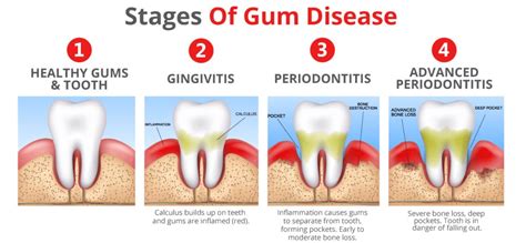 Gum Disease: Causes, Symptoms & Treatment