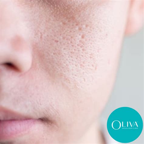 Open Pores: Treatments, Home Remedies, Tips & Results