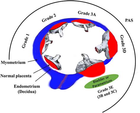 Histologic grading classification of placenta accreta spectrum (PAS)... | Download Scientific ...