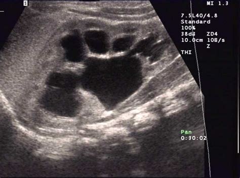 Hydronephrosis - Stepwards