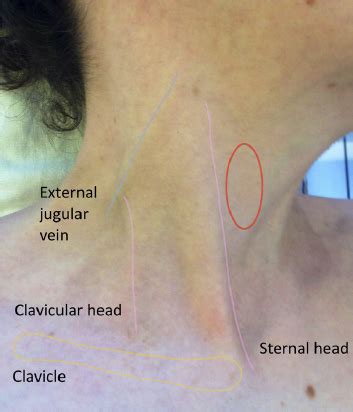 Where has the jugular venous pressure gone? - The British Journal of ...