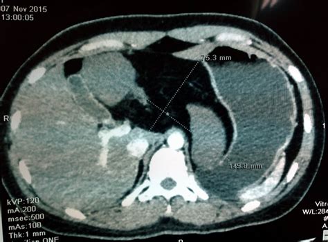 VIETNAMESE MEDIC ULTRASOUND: CASE 358: LESSER OMENTUM TUMOR, Dr PHAN THANH HAI , Dr VAN UYEN ...