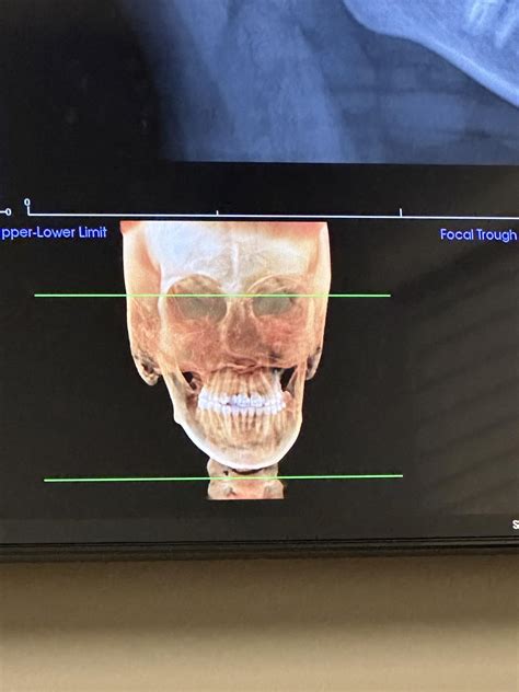 Does this picture show an asymmetrical jaw ? : r/jawsurgery