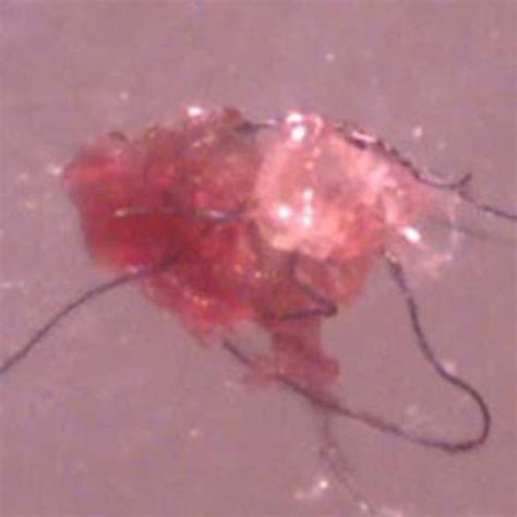 What is Morgellons Disease? Is it a physical or psychological condition? - Scientific American