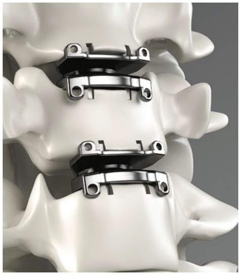 Bioengineering | Free Full-Text | Cervical and Lumbar Disc Arthroplasty ...