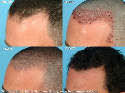 Hair Transplant in Islamabad: Efficient Hair Regrowth Treatments for Men