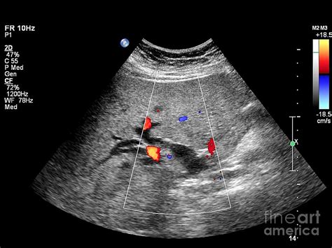 Gallstone, Doppler Ultrasound Scan Photograph by Science Photo Library ...