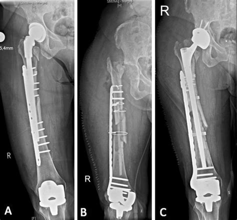 X-rays of case 2. a Periprosthetic infection after the treatment of a... | Download Scientific ...