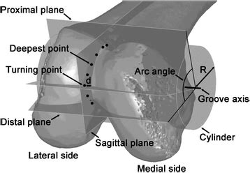 Methodology of classifying the trochlear groove tracking in terms of ...