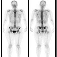 About the Bone Scan