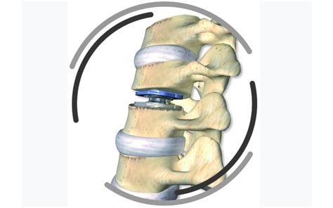 Cervical disc arthroplasty - Spinal Surgery News