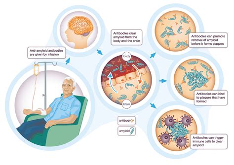 New Alzheimer’s drug, donanemab – what is it and how does it work? - Alzheimer's Research UK