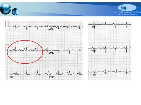 CVT Mohd Farid: Basic ECG Part III-P Wave & PR Interval