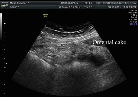 Transabdominal ultrasound showing omentum involvement in a woman with... | Download Scientific ...