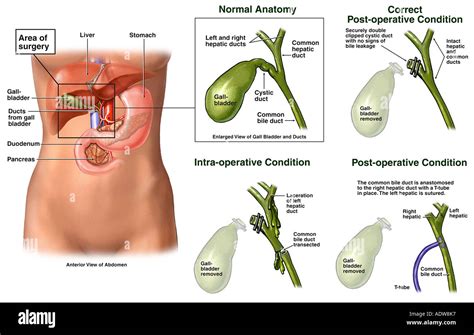 Cholecystectomy Gallbladder Surgery with Injury to the Common Bile Stock Photo, Royalty Free ...