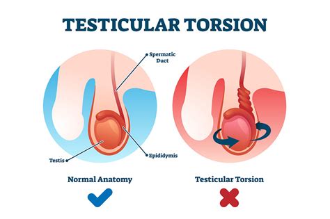 Testicular torsion - what all men and boys should know | Queensland Health