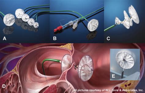 Single Centre Experience with GORE-HELEX Septal Occluder for Closure of PFO - Heart, Lung and ...