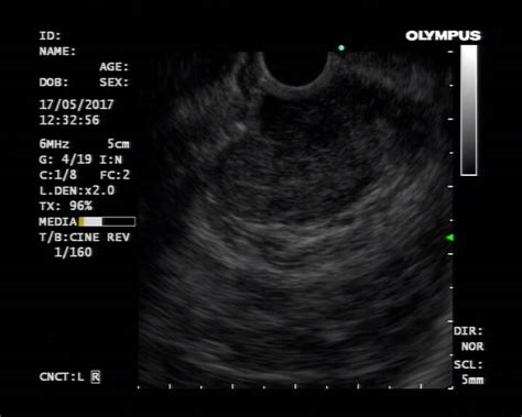 endoscopic-ultrasound