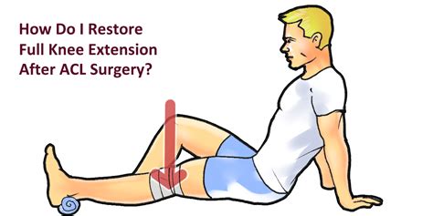 full-knee-extension-straightening-exercise-after-ACL-Surgery | Acl ...