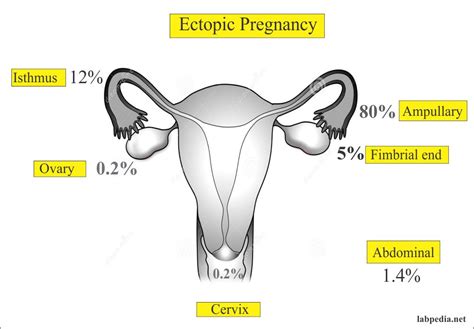 Ectopic Pregnancy and Its Diagnosis – Labpedia.net