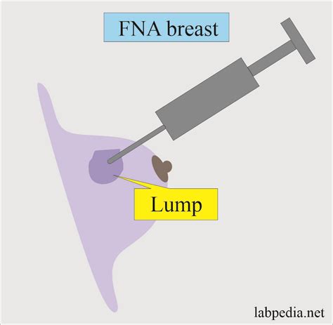 Fine Needle Aspiration Cytology (FNAC), Fine Needle Aspiration Biopsy ...